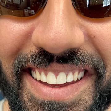 After composite veneers