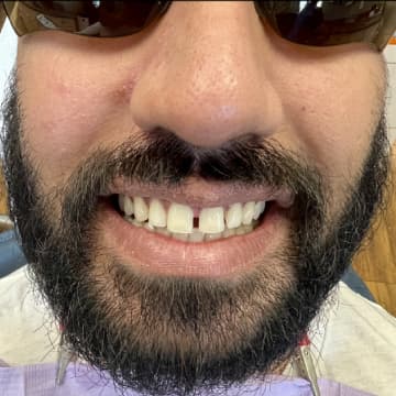 Before composite veneers