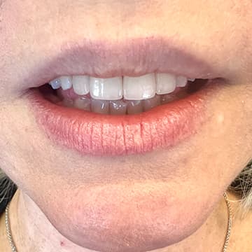 After porcelain crowns treatment