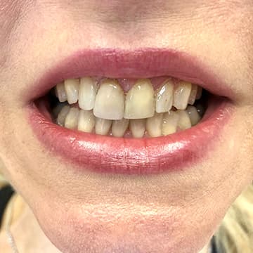 Before porcelain crowns treatment