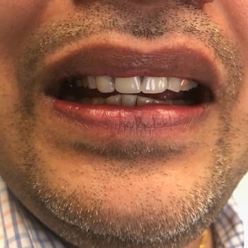 After smile transformation 01