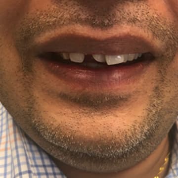 Before smile transformation 01