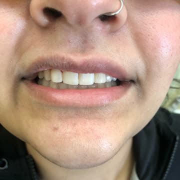 After smile transformation 03