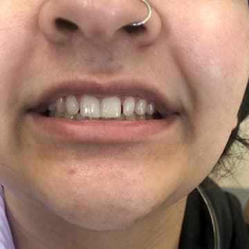 Before smile transformation 03