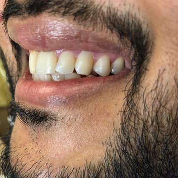 After smile transformation 04