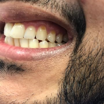 Before smile transformation 04