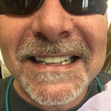 After smile transformation 05