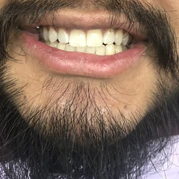After smile transformation 06