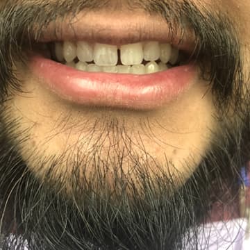 Before smile transformation 06