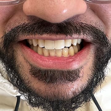 After Bioclear composite veneers