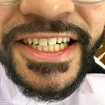 Before Bioclear composite veneers